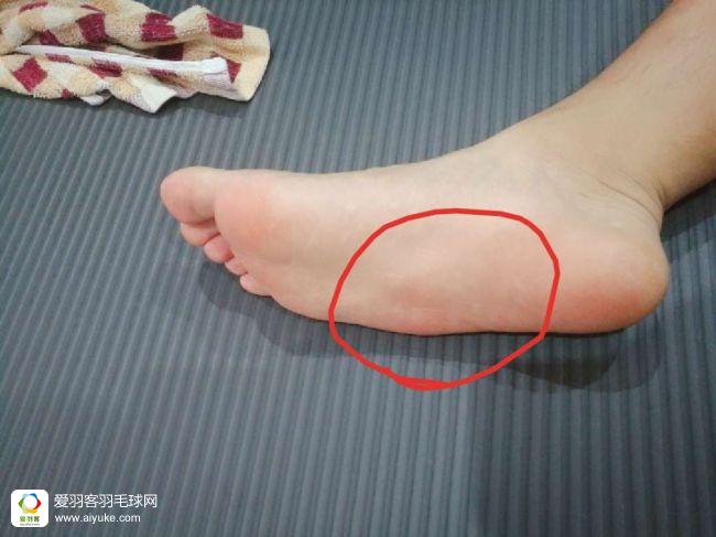 脚底板痛当心你可能患了足底筋膜炎